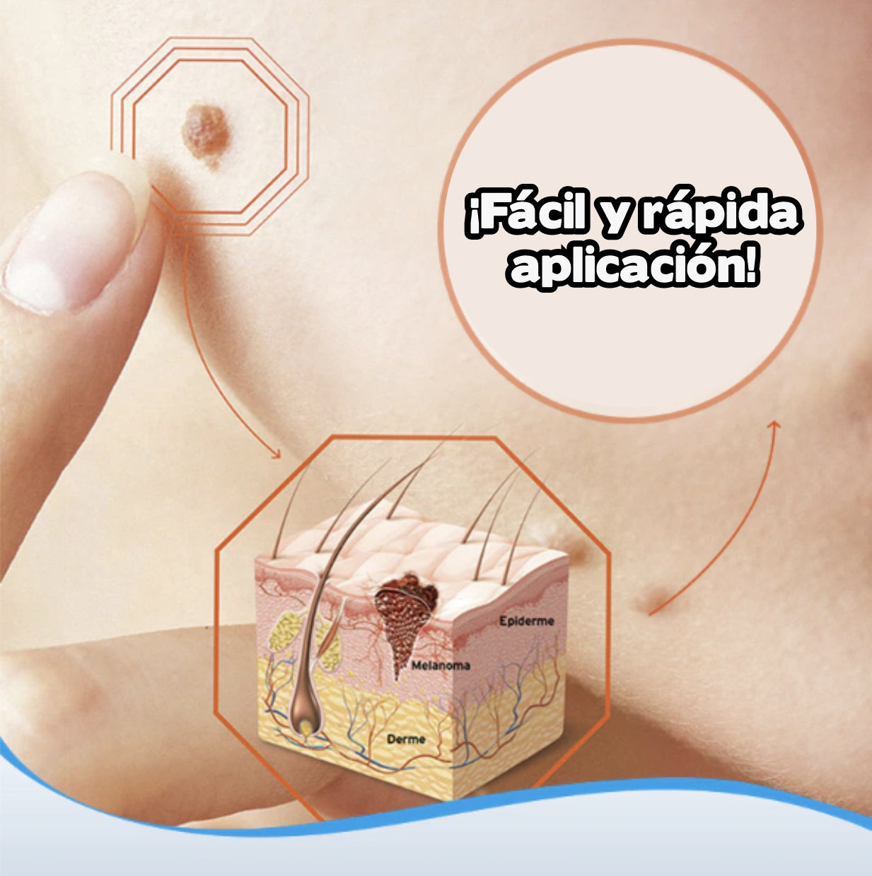 Crema removedora de verrugas - WartOff™